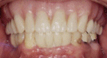 implants roselle dentist