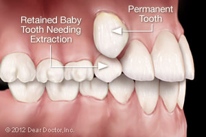 Teeth Extractions | Dentist in Roselle, IL | Roselle Dental Associates